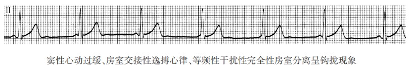 窦性心动过缓、房室交接性逸搏心律、等频性干扰性完全性房室分离呈钩拢现象