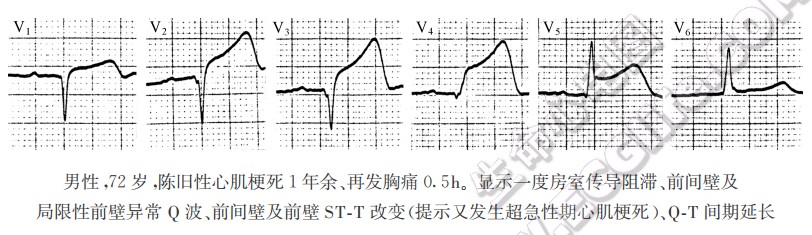 再发性心肌梗死（复发性心肌梗死）