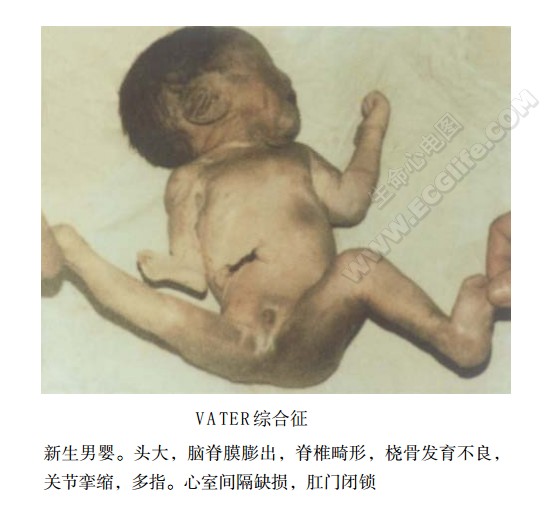 VATER综合征（VACTERL联合征、VACTERL联合畸形）患儿表现