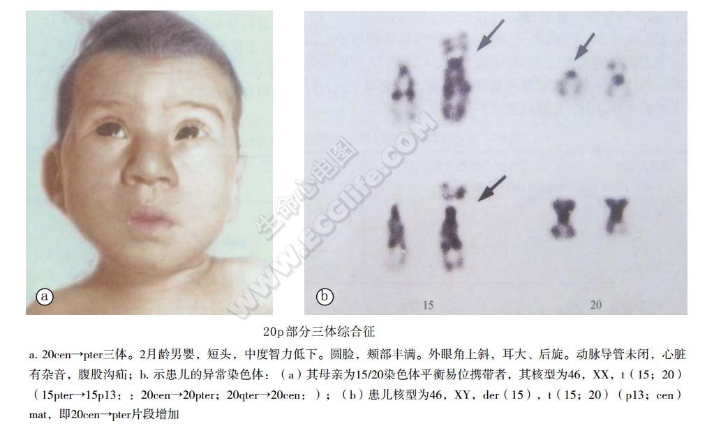 20p部分三体综合征患者表现