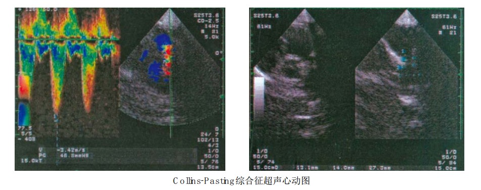 Collins-Pasting综合征患者超声心动图