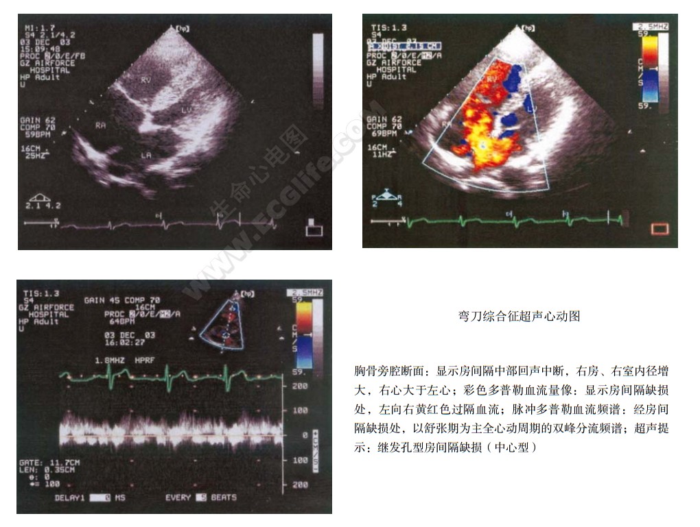 弯刀综合征（心肺发育不全军刀综合征）超声心动图