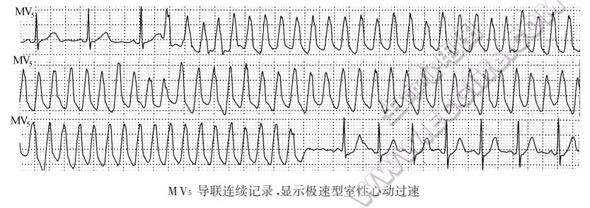 圾速型室性心动过速-心电图