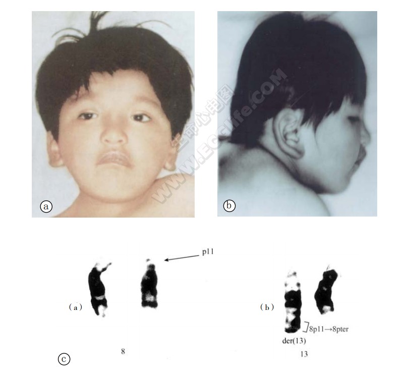 8p部分三体综合征患者表现