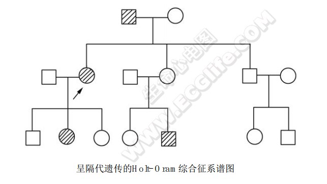 Holt-Oram综合征（小儿手-心畸形综合征）系谱图