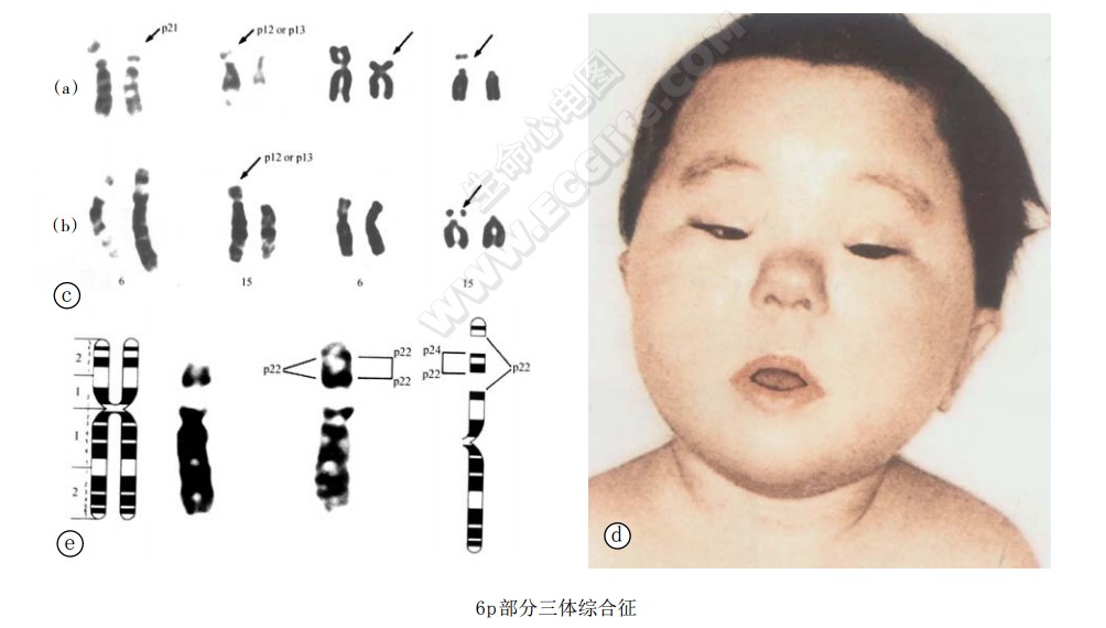 6p部分三体综合征患者与染色体