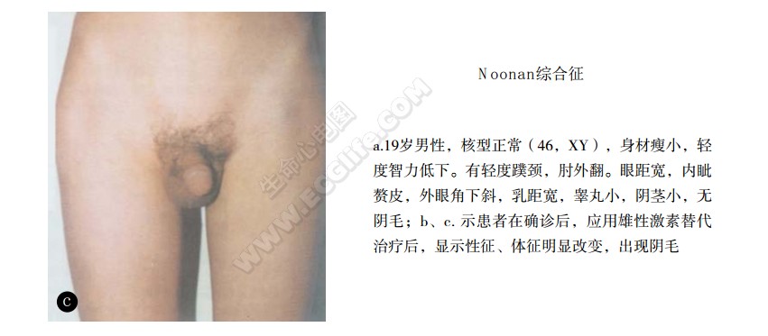 Noonan综合征（努南综合征、先天性侏儒痴呆综合征）雄性激素替代治疗