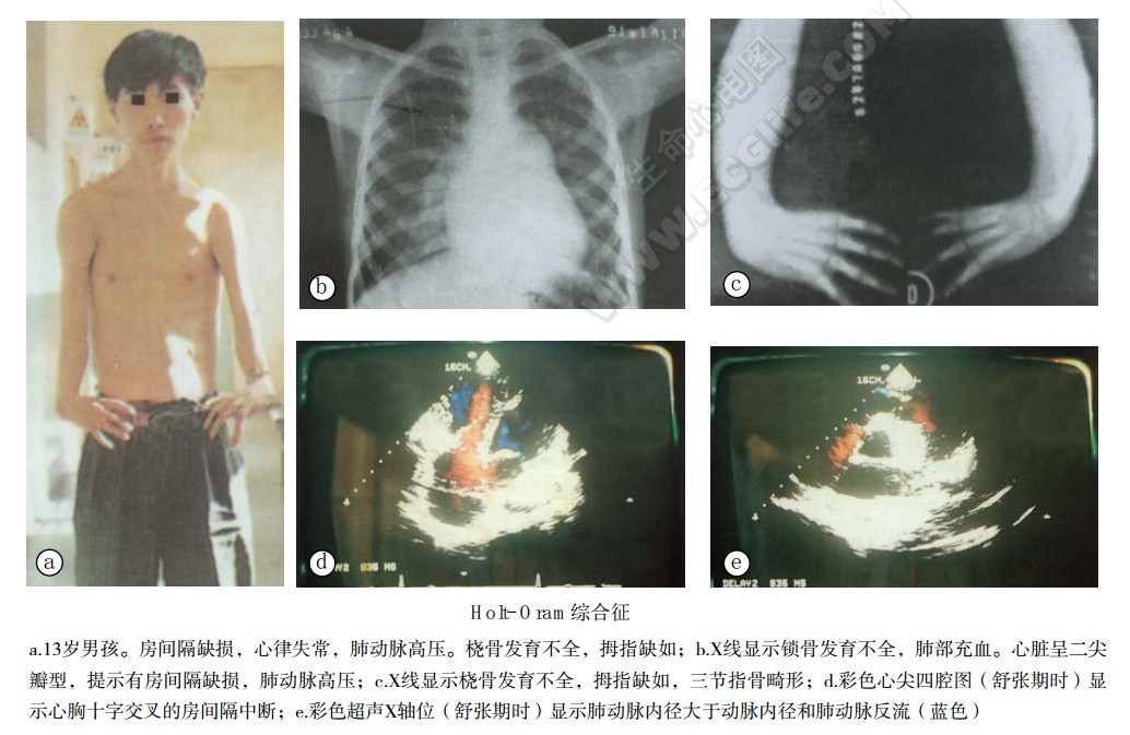Holt-Oram综合征（小儿手-心畸形综合征）