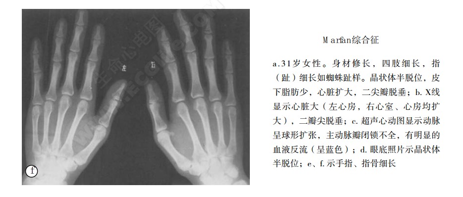 Marfan综合征（马方综合征、马凡氏综合征）患者症状表现2