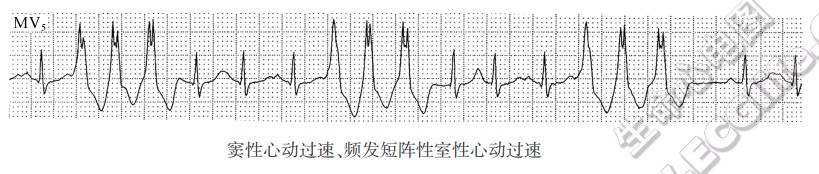 窦性心动过速、频发短I哞性室性心动过速（心电图）