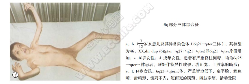 6q部分三体综合征患者表现