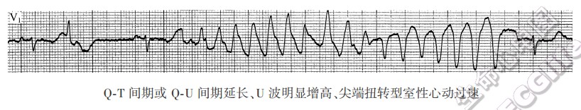 QT间期或QU间期延长、U波明显增高、尖端扭转型室性心动过速-心电图