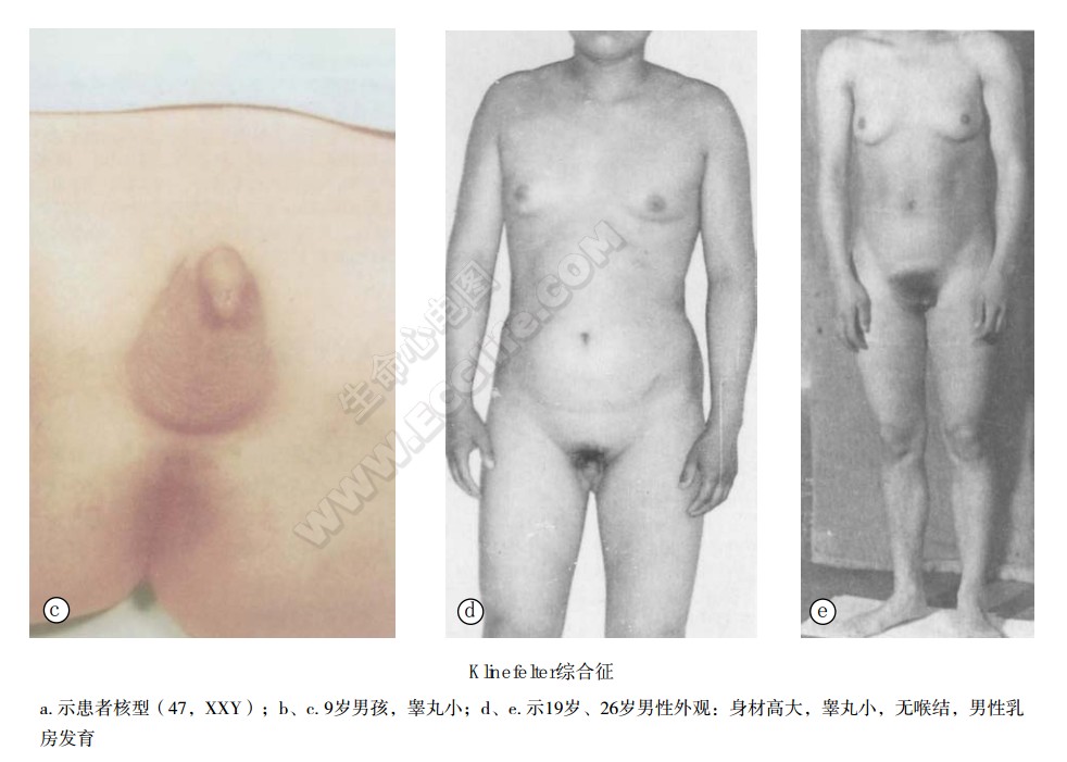 Klinefelter综合征（先天性睾丸发育不全，XXY综合征）患者表现
