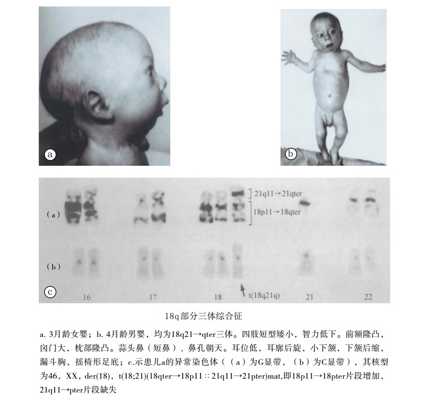 18q部分三体综合征