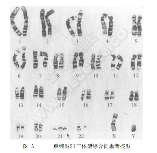 单纯型21三体型综合征患者核型