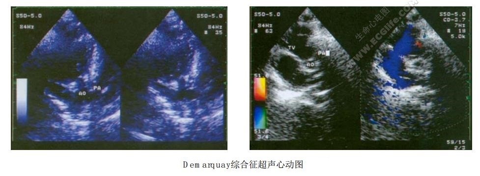 Demarquay综合征（下唇凹陷-唇裂和/或腭裂综合征）超声心动图