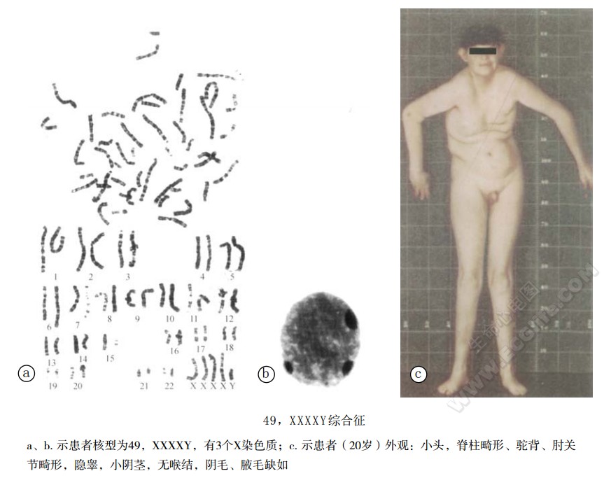 49，XXXXY综合征患者表现