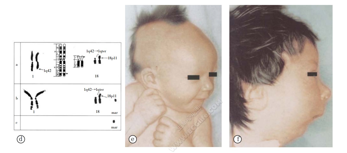 1q部分三体综合征患者表现2