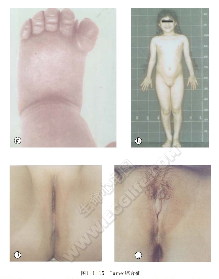 Turner综合征（X单体综合征）患者脚水中、外生殖器发育迟缓