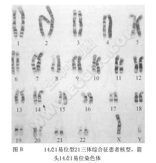 14/21易位型21三体综合征患者核型，箭头14/21易位染色体