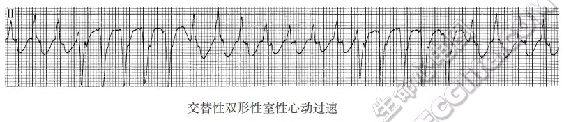 交替性双形性室性心动过速-心电图