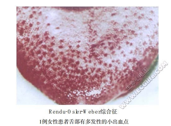 Rendu-Osler-Weber综合征（遗传性出血性毛细血管扩张症）患者表现