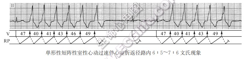 单形性短阵性窒性心动过速伴心室折返径路内6：5～7：6文氏现象（心电图）