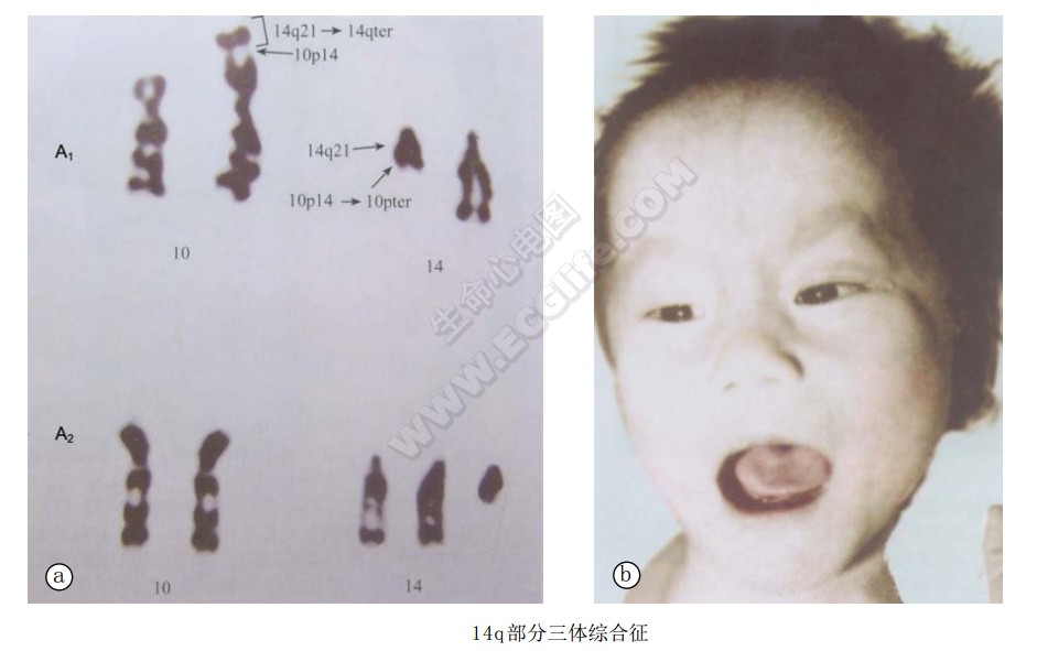 14q部分三体综合征患者表现