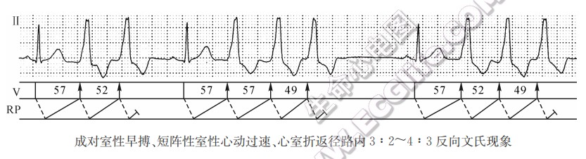 成对室性早搏、短阵性窒性心动过速、心室折返径路内3：2～4：3反向文氏现象（心电图）