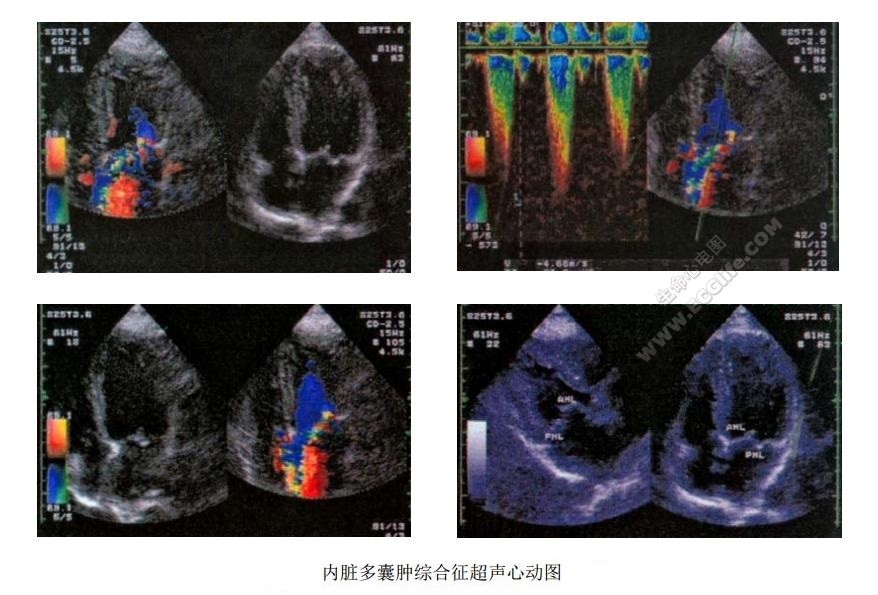 APKD：成人型多囊肾（内脏多囊肿病、成人型内脏多囊病）