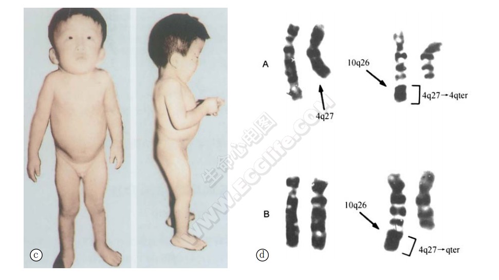 4q部分三体综合征患者表现与染色体