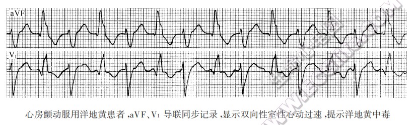 心房颤动服用洋地黄患者，aVF、V1导联同步记录湿示双向性室性心动过速，提示洋地黄中毒-心电图