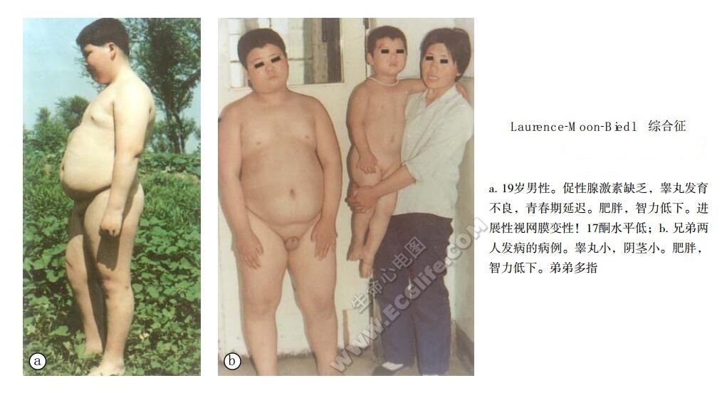 Laurence-Moon-Biedl综合征（肥胖生殖无能综合征）、视网膜变性-肥胖-多指综合征患者