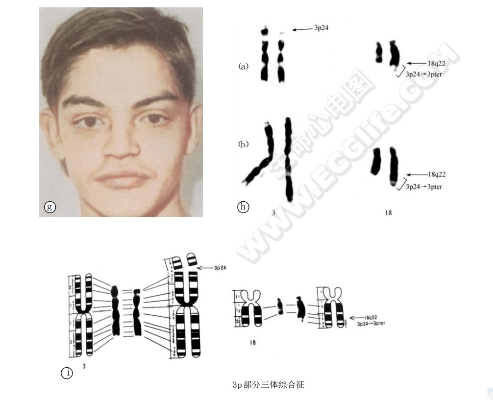 3p部分三体综合征、异常染色体