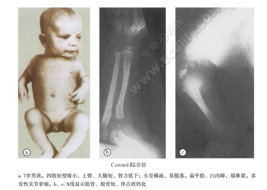 Conradi综合征（AR型点状软骨发育不全、胎儿软骨发育不良）患者表现