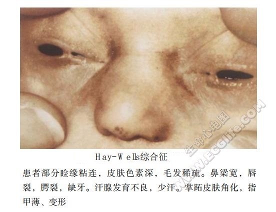 Hay-Wells综合征（AEC综合征）患者表现