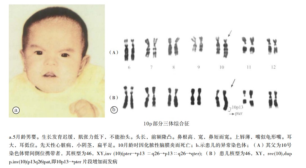 10p部分三体综合征