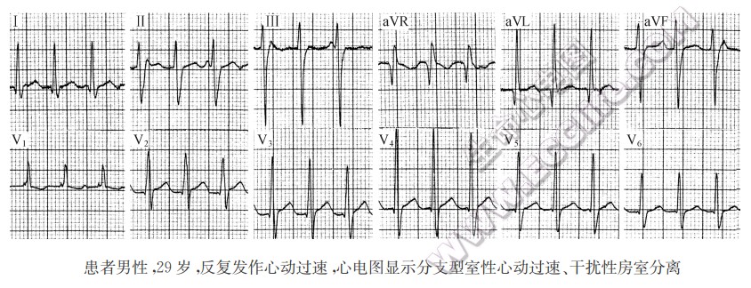 患者男性，29岁，反复发作心动过速，心电图显示分支型室性心动过速、干扰性房室分离