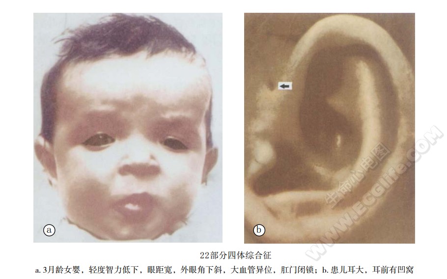 22部分四体综合征（猫眼综合征）