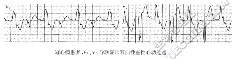 冠心病患者，V1、V2导联显示双向性室性心动过速-心电图