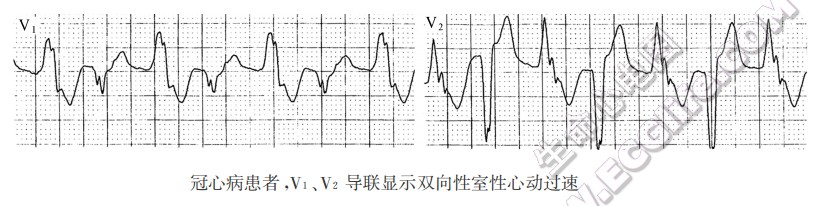 冠心病患者，V1、V2导联显示双向性室性心动过速-心电图