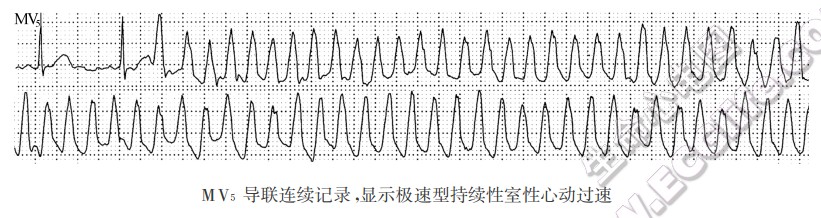 MV5导联连续记录，显示极速型持续性室性心动过速（心电图）