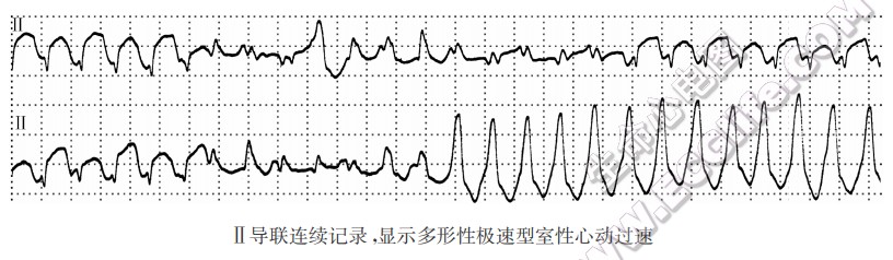 Ⅱ导联连续记录，显示多形性极速型窒性心动过速-心电图