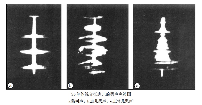 5p单体综合征患儿的哭声声波图