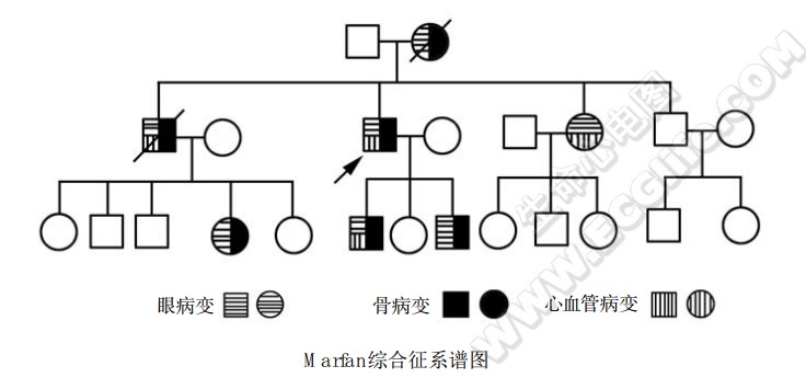 Marfan综合征（马方综合征、马凡氏综合征）