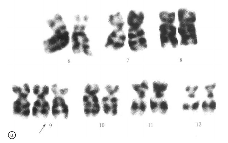 9三体综合征9号染色体三体