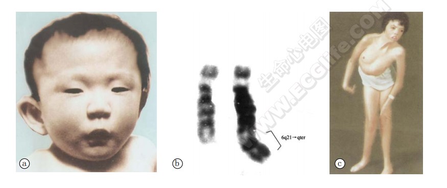 6q部分三体综合征患者1