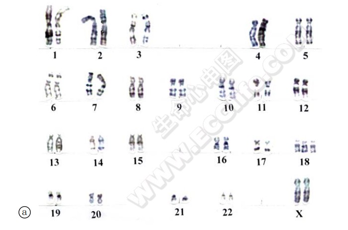 18三体综合征女性患者的核型