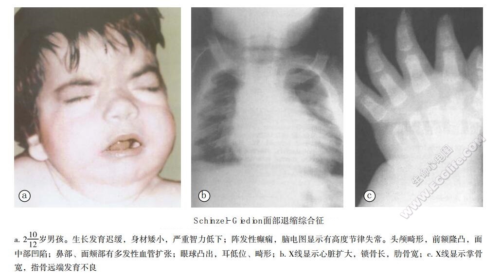 Schinzel-Giedion面部退缩综合征患者表现