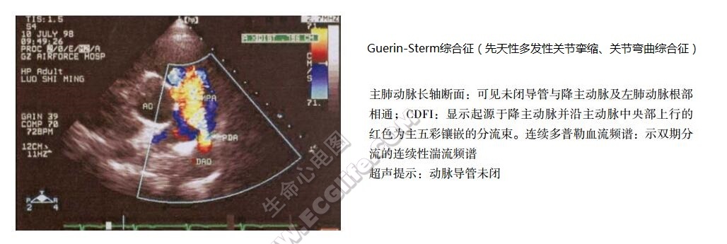 Guerin-Sterm综合征（先天性多发性关节挛缩、关节弯曲综合征）超声心动图表现
